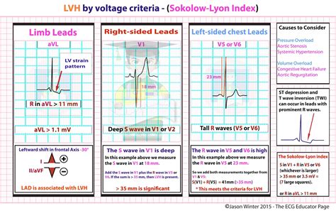 minimal voltage criteria for lvh|criteria for lvh on ecg.